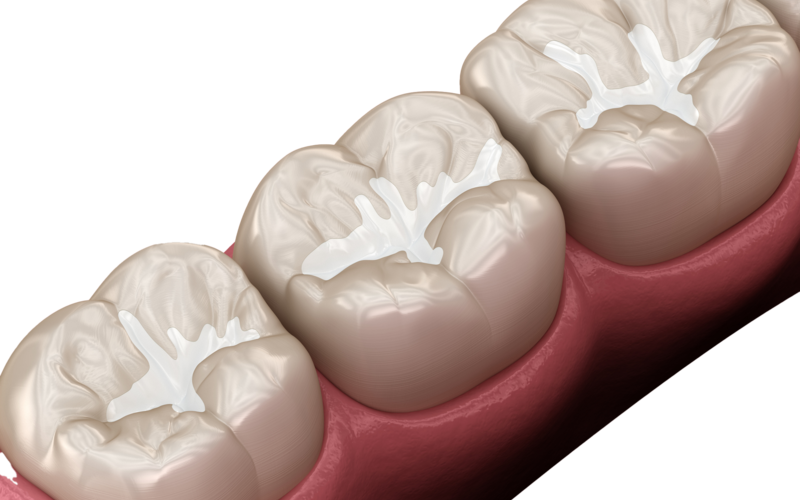 Are Dental Sealants Necessary?