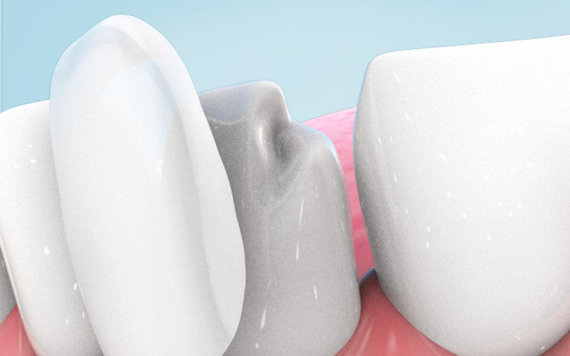 Designing Your Custom Smile with Dental Veneers